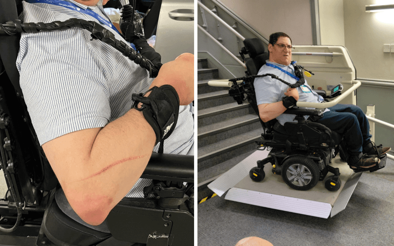 The right arm of Clive Gilbert, showing a long deep scratch, as he sits in his powerchair. A separate picture shows Clive sitting in his powerchair on a platform lift that is suspended in the air